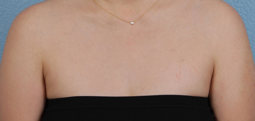 Laser Tattoo Removal Before & After Gallery - Patient 229615 - Image 2