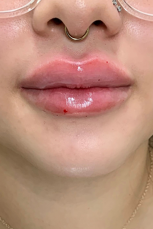 Hidden Patients Before & After Gallery - Patient 405070 - Image 2