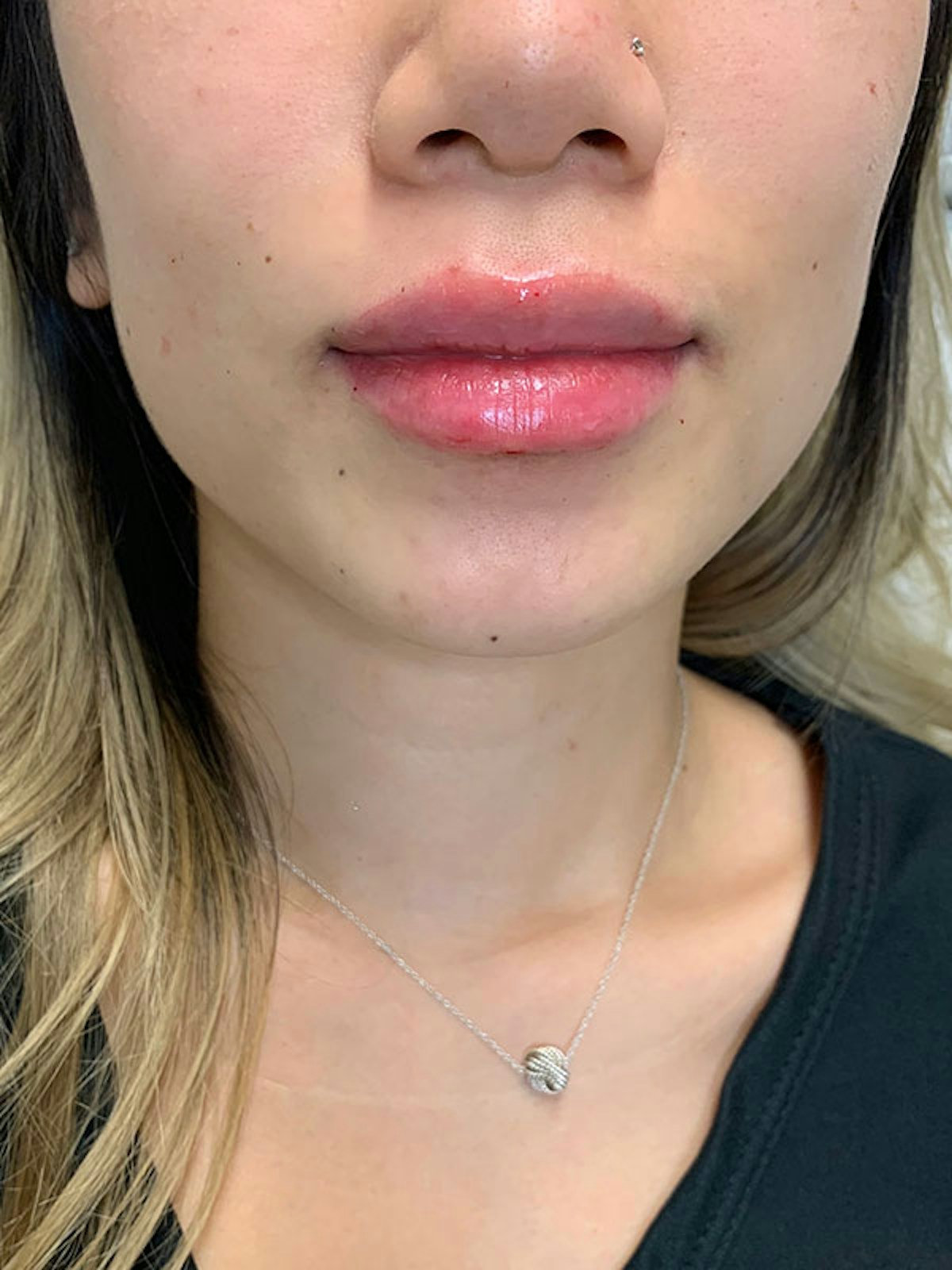 Lip Fillers Before & After Gallery - Patient 176077 - Image 2