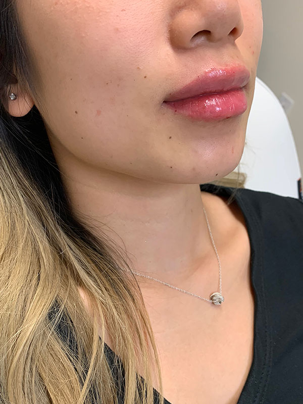 Dermal Fillers Before & After Gallery - Patient 496630 - Image 4