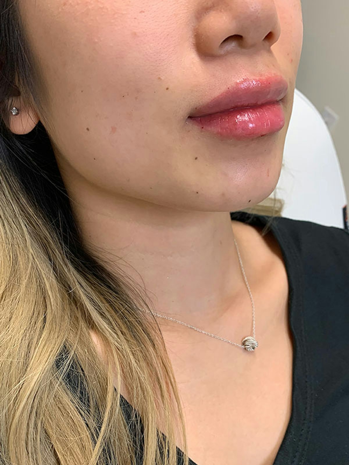 Lip Fillers Before & After Gallery - Patient 176077 - Image 4