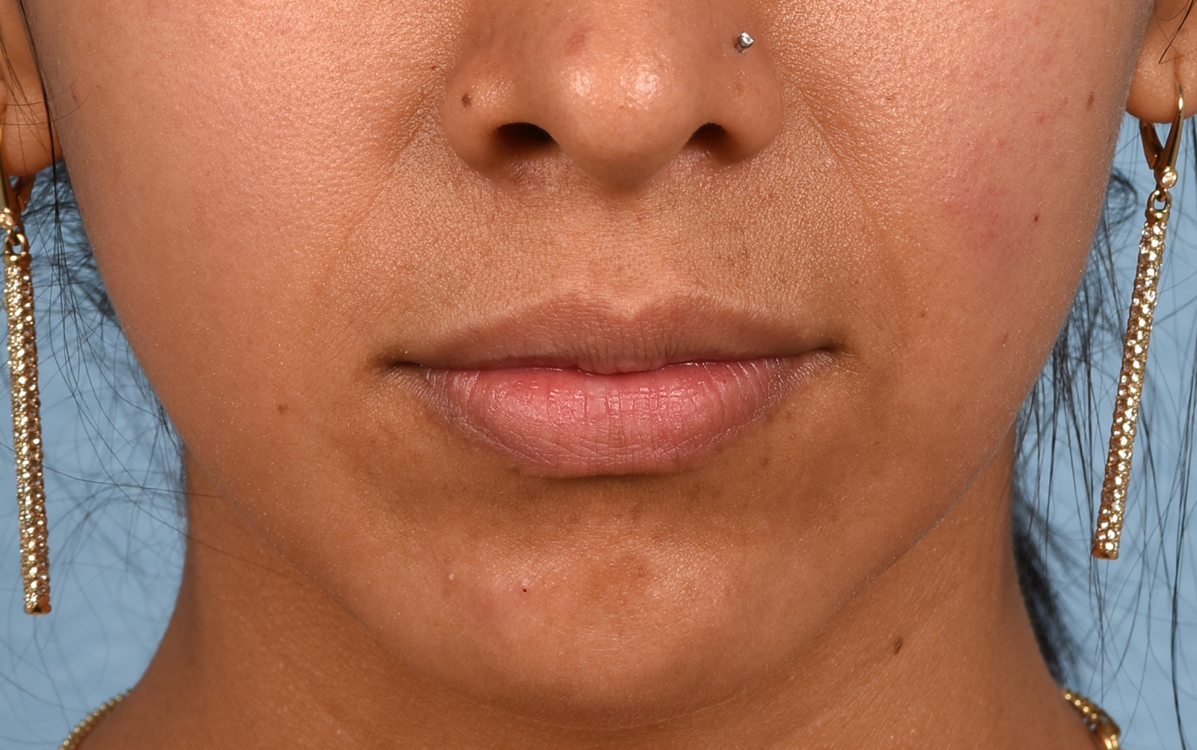 Hidden Patients Before & After Gallery - Patient 363876 - Image 1