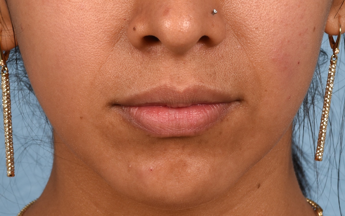 Lip Fillers Before & After Gallery - Patient 247149 - Image 1