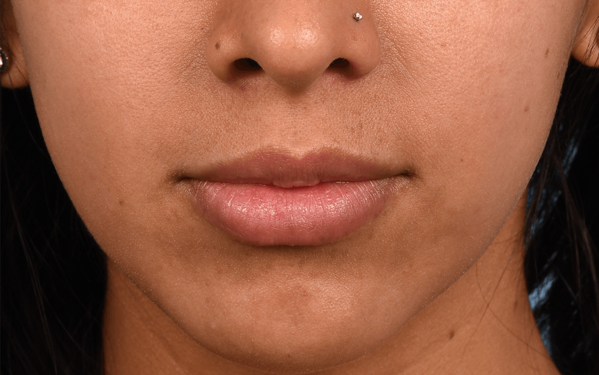 Lip Fillers Before & After Gallery - Patient 247149 - Image 2