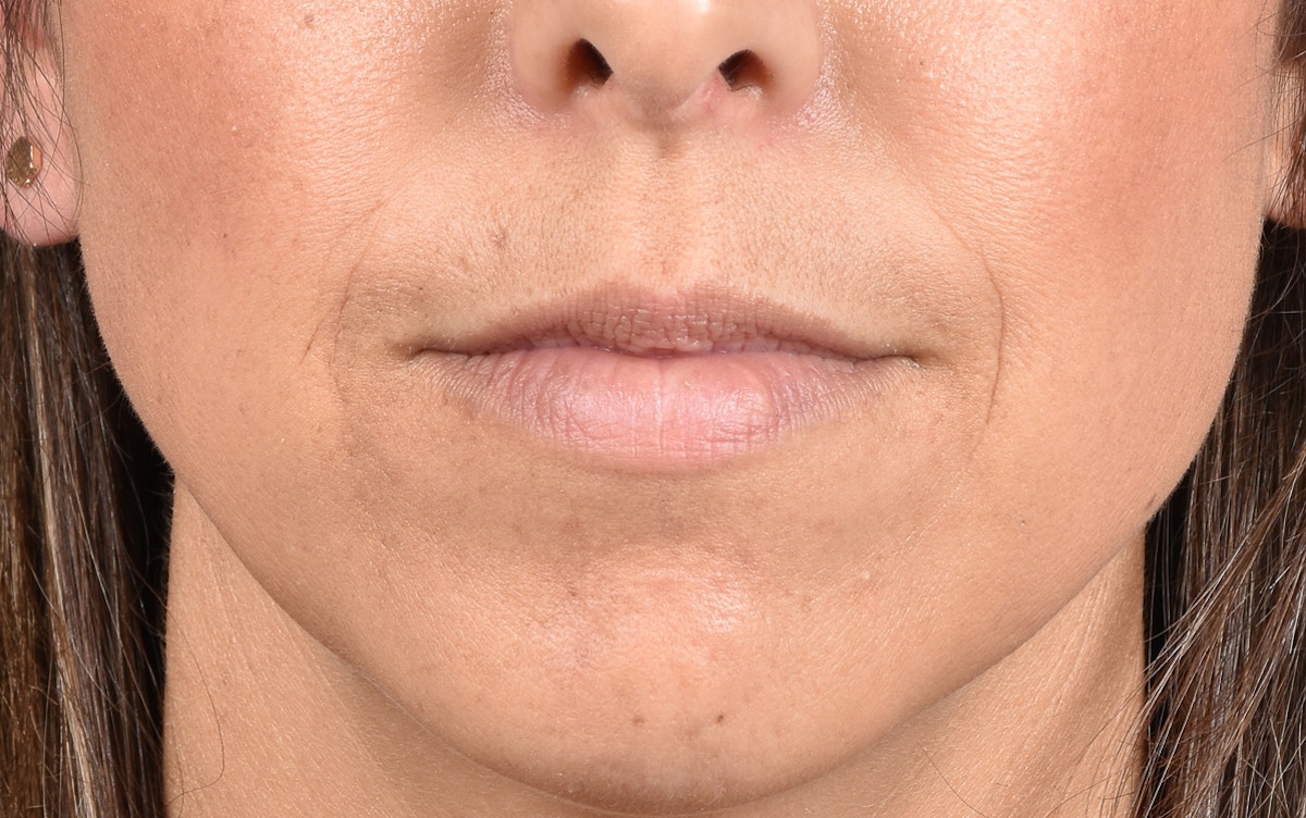 Lip Fillers Before & After Gallery - Patient 399813 - Image 1