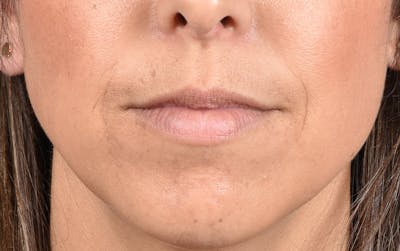 Dermal Fillers Before & After Gallery - Patient 572156 - Image 1