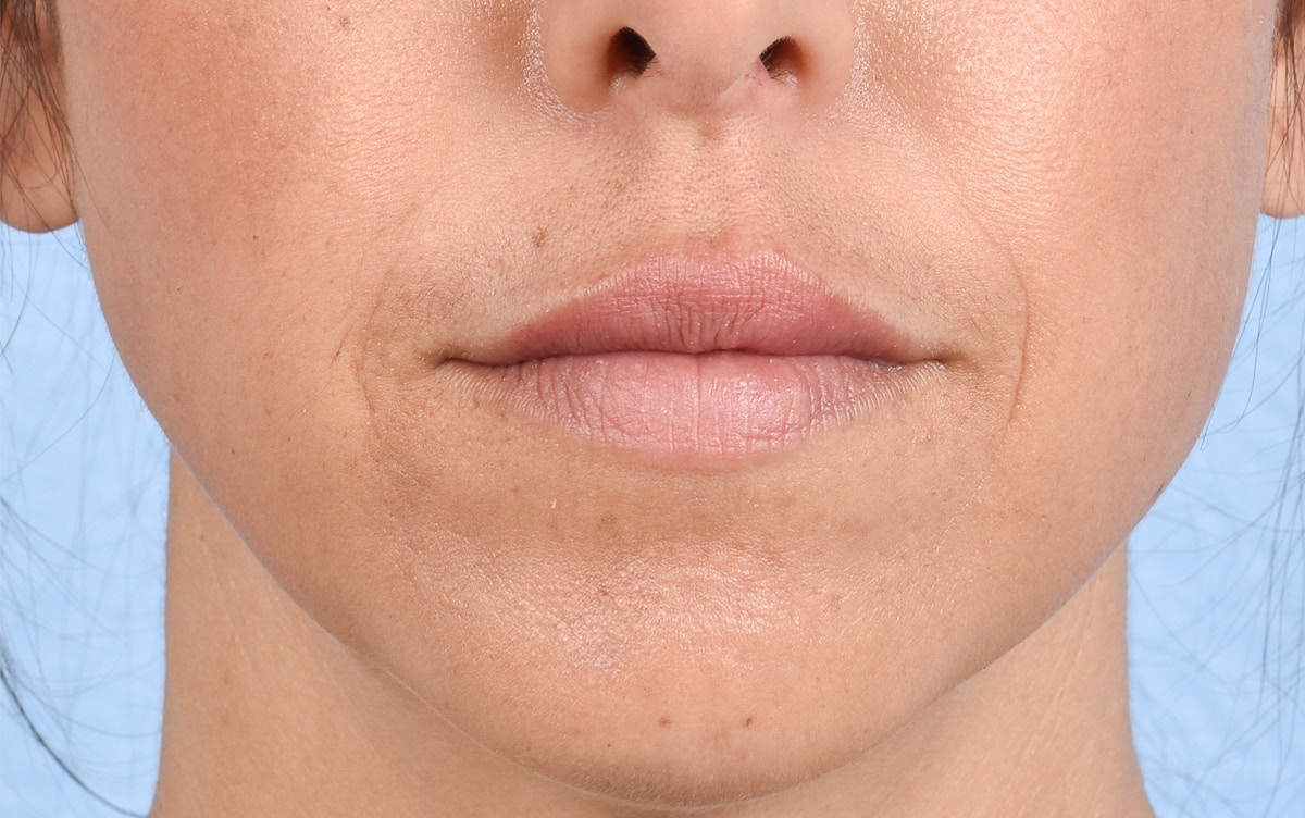 Lip Fillers Before & After Gallery - Patient 399813 - Image 2