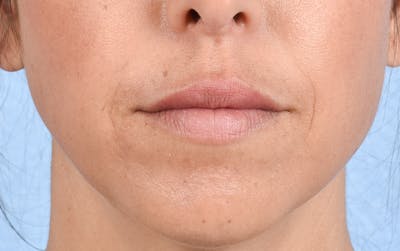 Dermal Fillers Before & After Gallery - Patient 572156 - Image 2