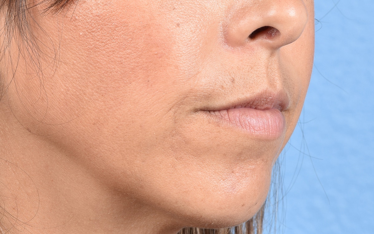 Lip Fillers Before & After Gallery - Patient 399813 - Image 3