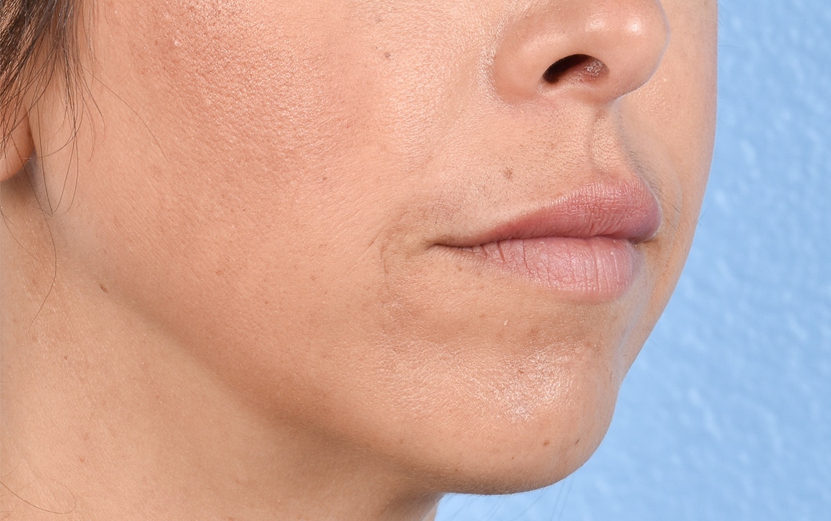 Lip Fillers Before & After Gallery - Patient 399813 - Image 4