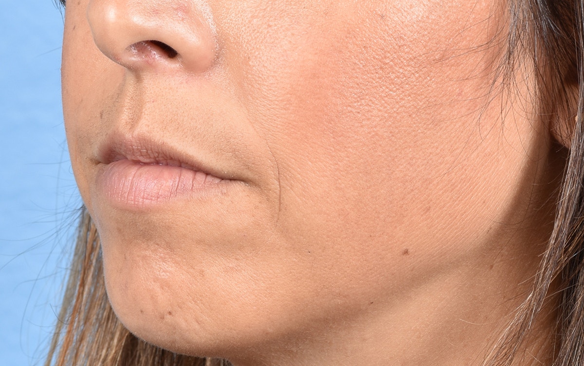 Lip Fillers Before & After Gallery - Patient 399813 - Image 5