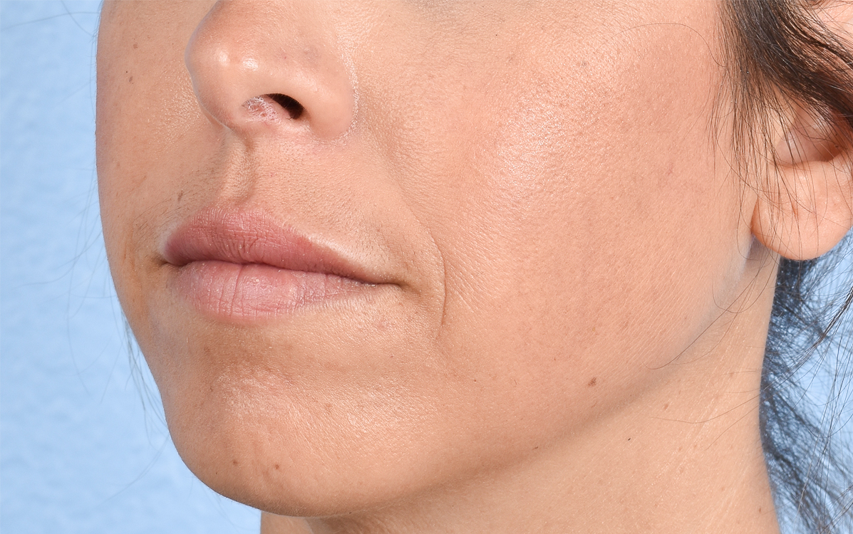 Dermal Fillers Before & After Gallery - Patient 572156 - Image 6