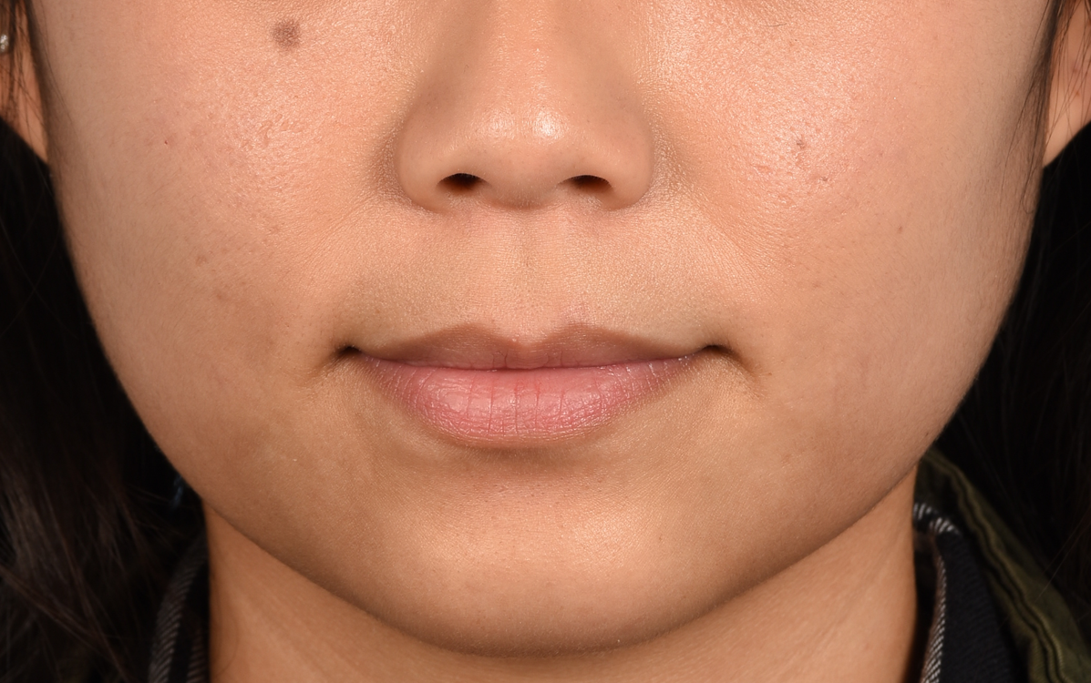 Dermal Fillers Before & After Gallery - Patient 720528 - Image 1
