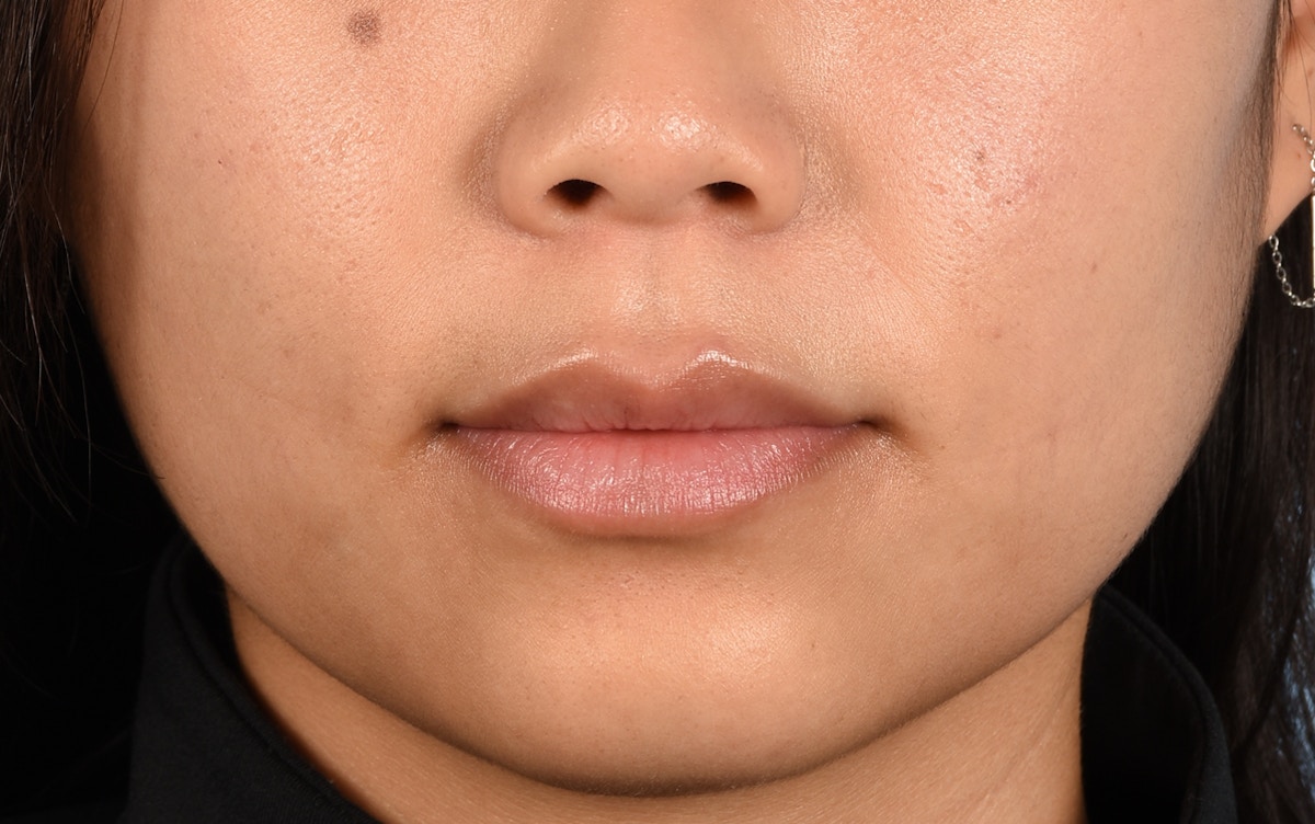 Lip Fillers Before & After Gallery - Patient 858420 - Image 2