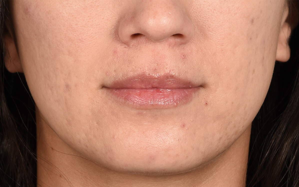 Hidden Patients Before & After Gallery - Patient 337844 - Image 1