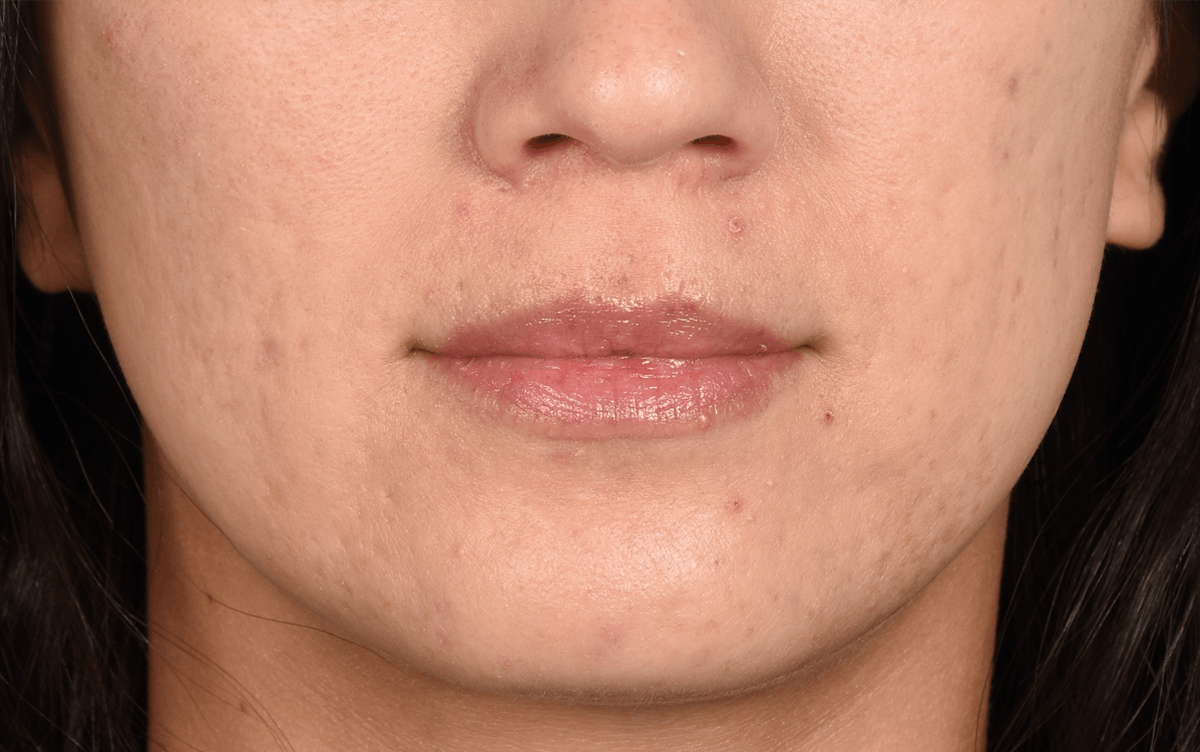 Lip Fillers Before & After Gallery - Patient 262396 - Image 1