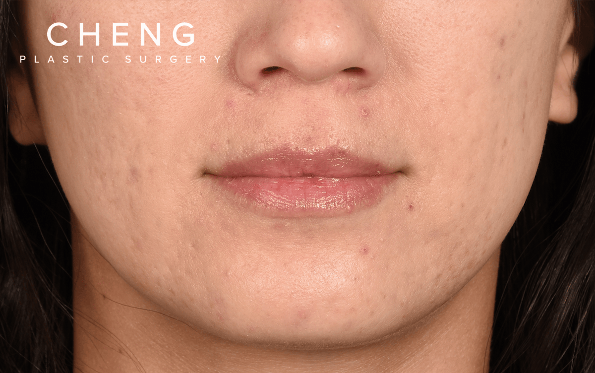 Hidden Patients Before & After Gallery - Patient 337844 - Image 1