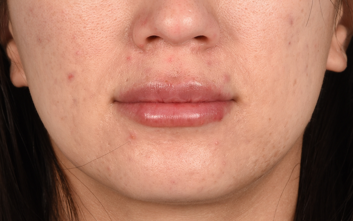 Hidden Patients Before & After Gallery - Patient 337844 - Image 2