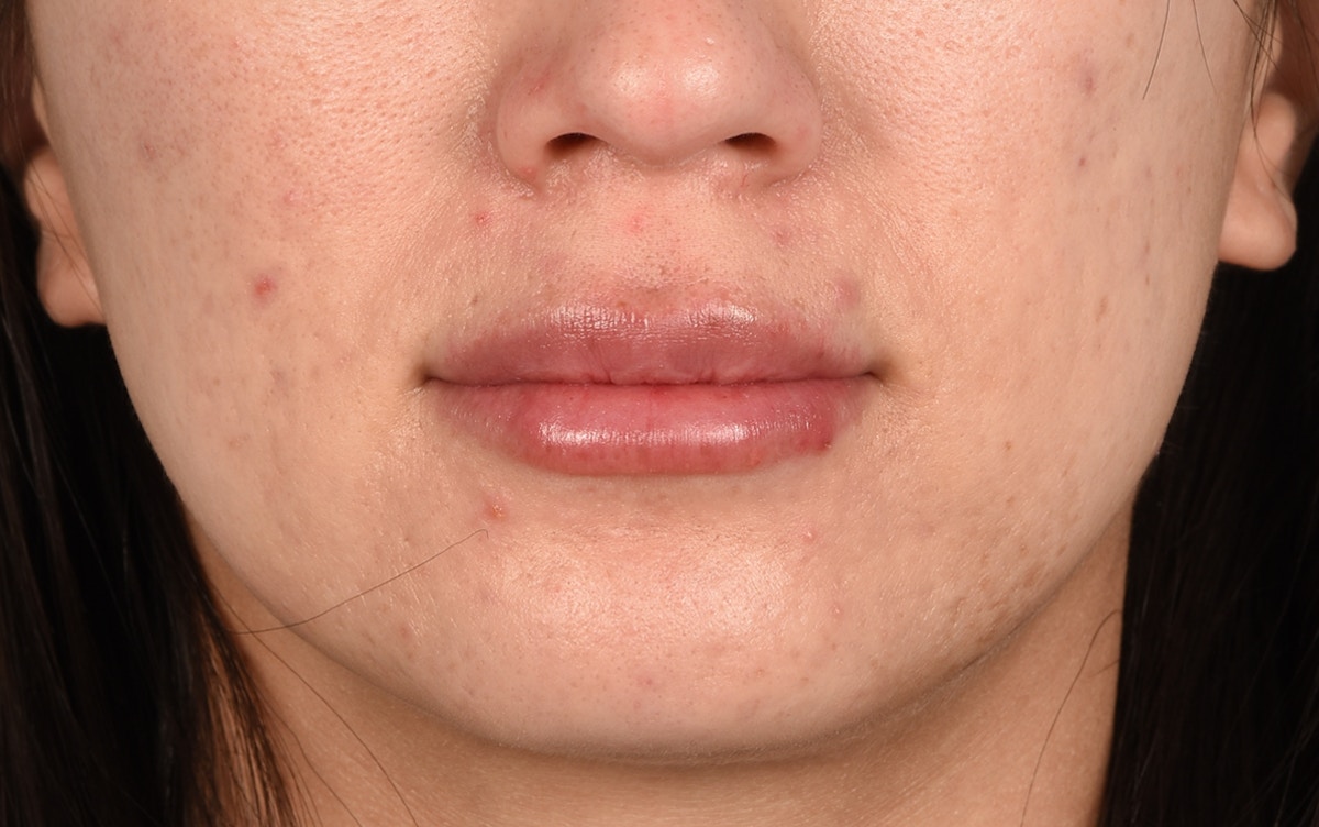 Lip Fillers Before & After Gallery - Patient 262396 - Image 2