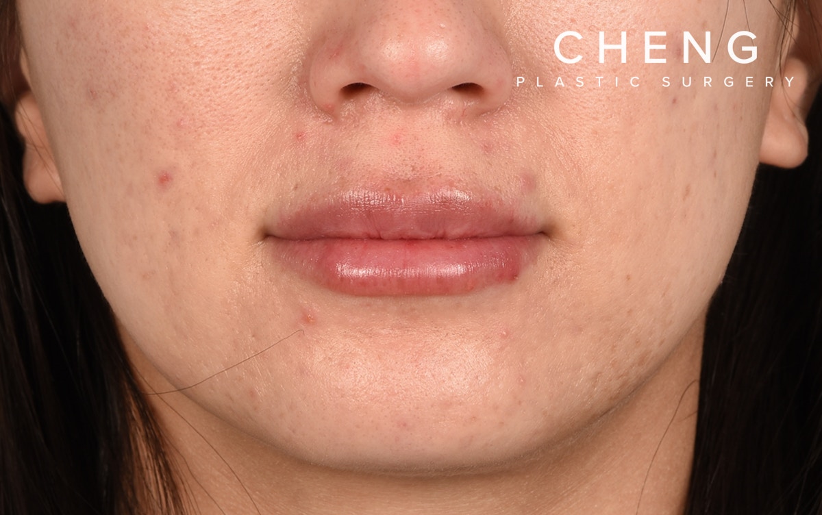 Hidden Patients Before & After Gallery - Patient 337844 - Image 2