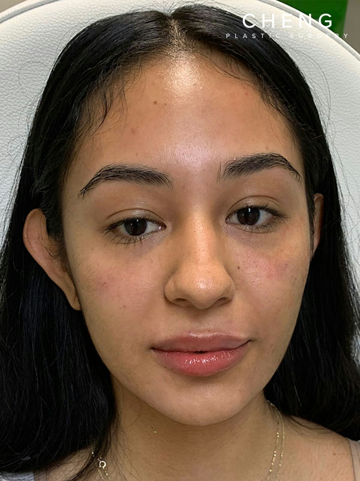 Hidden Patients Before & After Gallery - Patient 105891 - Image 2