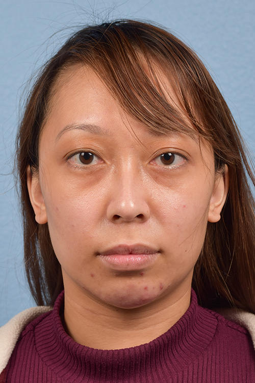 Dermal Fillers Before & After Gallery - Patient 959337 - Image 1