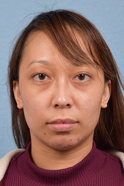 Facial Fillers Before & After Gallery - Patient 959337 - Image 1