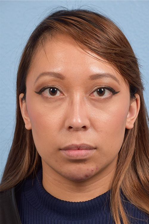 Dermal Fillers Before & After Gallery - Patient 959337 - Image 2