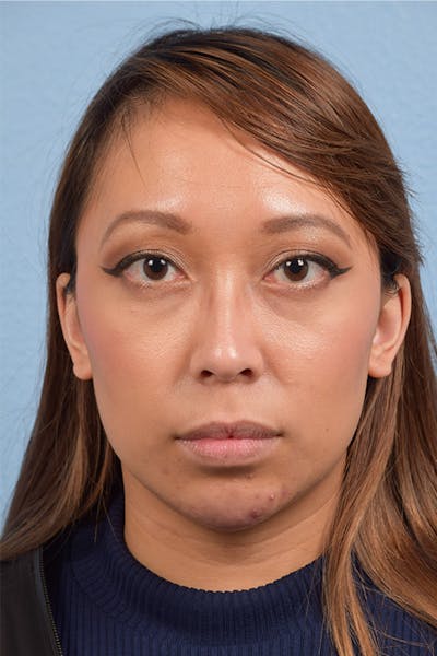 Facial Fillers Before & After Gallery - Patient 959337 - Image 2