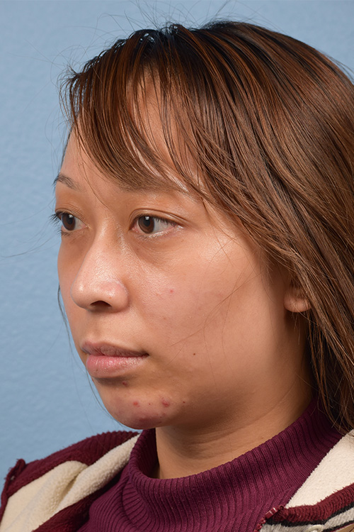 Dermal Fillers Before & After Gallery - Patient 959337 - Image 3