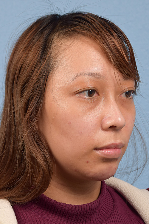 Dermal Fillers Before & After Gallery - Patient 959337 - Image 5