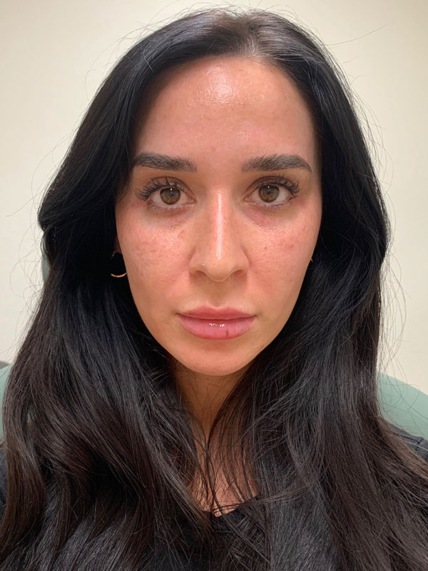 Dermal Fillers Before & After Gallery - Patient 167884 - Image 1