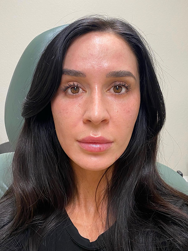 Dermal Fillers Before & After Gallery - Patient 167884 - Image 2