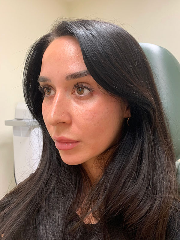 Dermal Fillers Before & After Gallery - Patient 167884 - Image 3