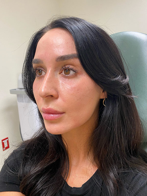 Dermal Fillers Before & After Gallery - Patient 167884 - Image 4