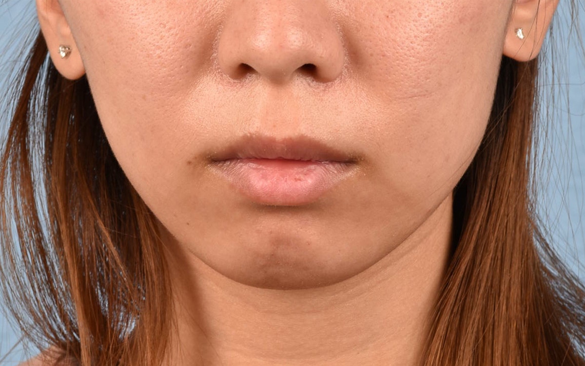Facial Fillers Before & After Gallery - Patient 252596 - Image 1