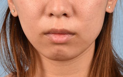 Facial Fillers Before & After Gallery - Patient 252596 - Image 1