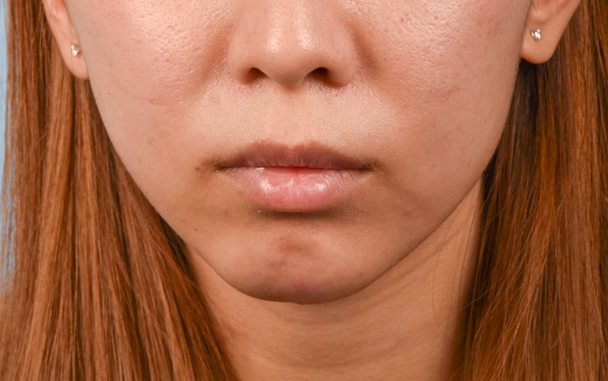 Facial Fillers Before & After Gallery - Patient 252596 - Image 2