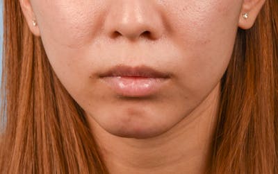 Facial Fillers Before & After Gallery - Patient 252596 - Image 2