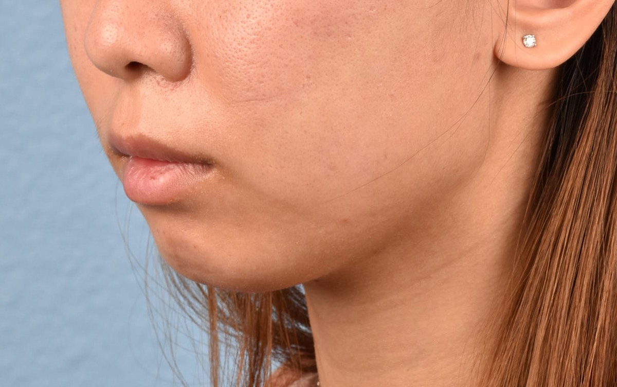 Facial Fillers Before & After Gallery - Patient 252596 - Image 3