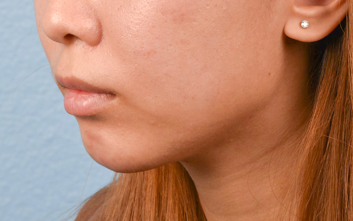 Dermal Fillers Before & After Gallery - Patient 252596 - Image 4