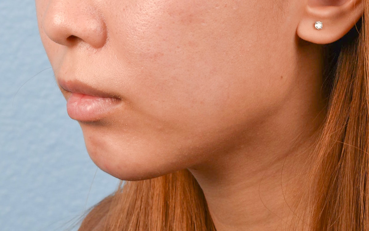 Facial Fillers Before & After Gallery - Patient 252596 - Image 4