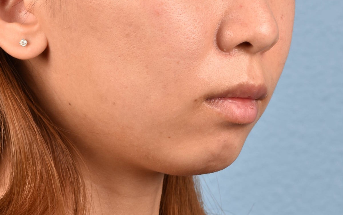 Facial Fillers Before & After Gallery - Patient 252596 - Image 5