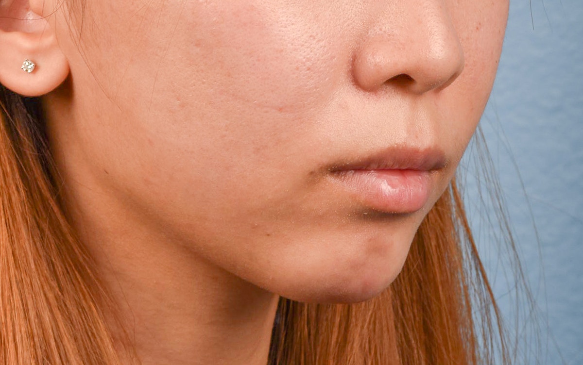 Facial Fillers Before & After Gallery - Patient 252596 - Image 6