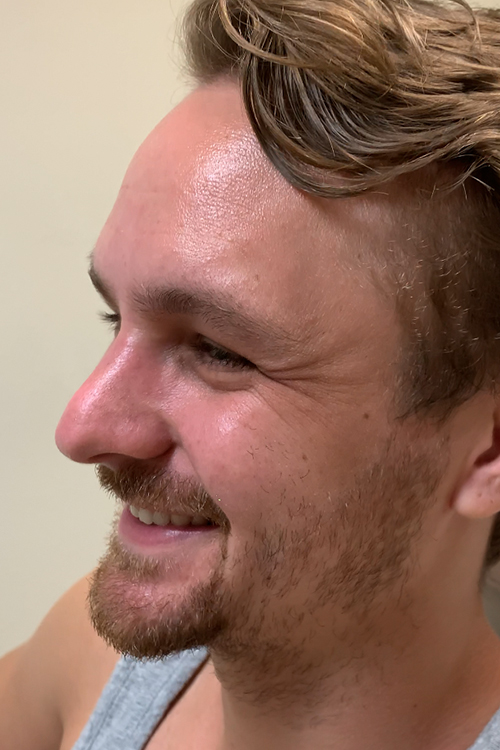 Botox and Dysport Before & After Gallery - Patient 404936 - Image 1