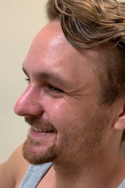 Wrinkle Relaxers Before & After Gallery - Patient 404936 - Image 1