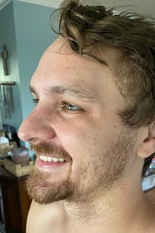 Botox and Dysport Before & After Gallery - Patient 404936 - Image 2