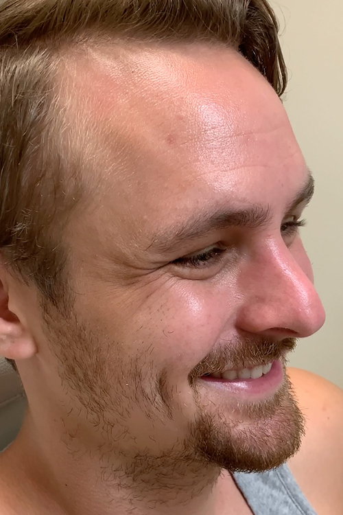 Botox and Dysport Before & After Gallery - Patient 404936 - Image 3