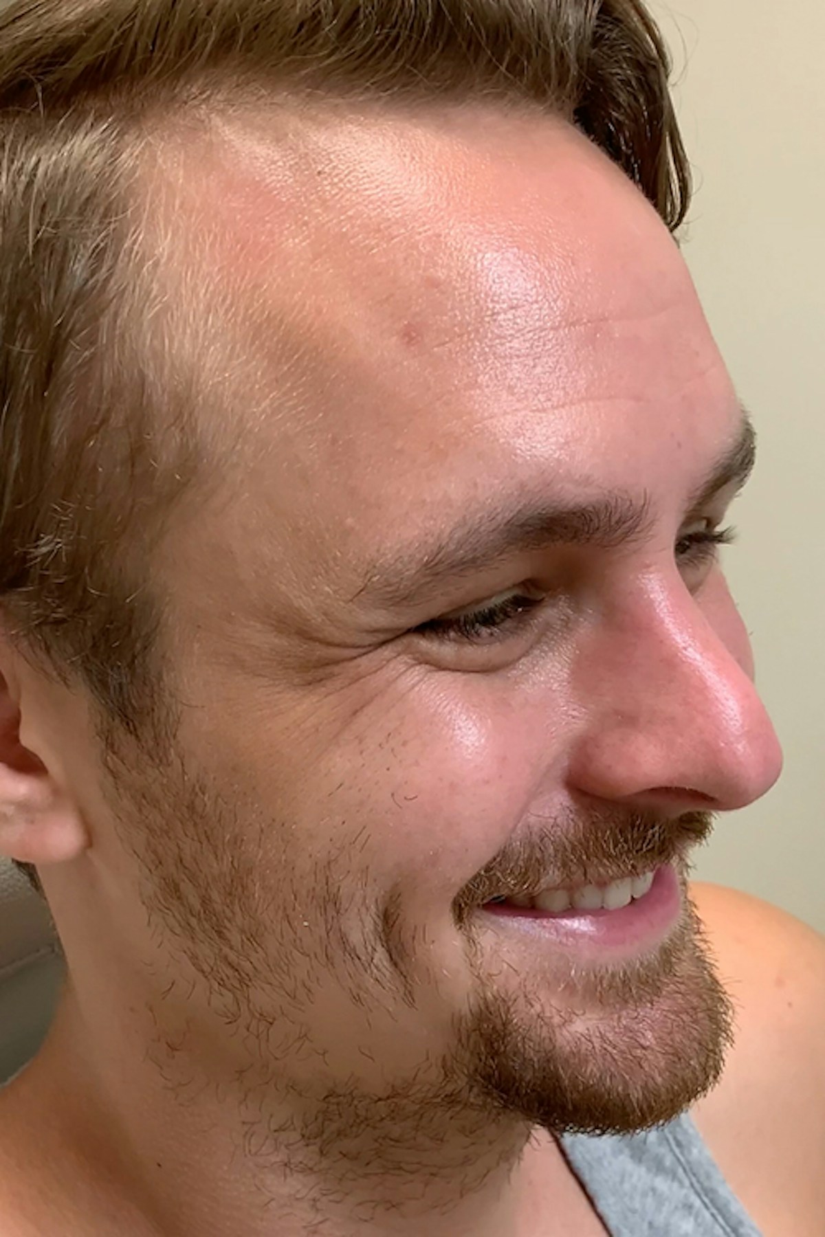 Wrinkle Relaxers Before & After Gallery - Patient 404936 - Image 3