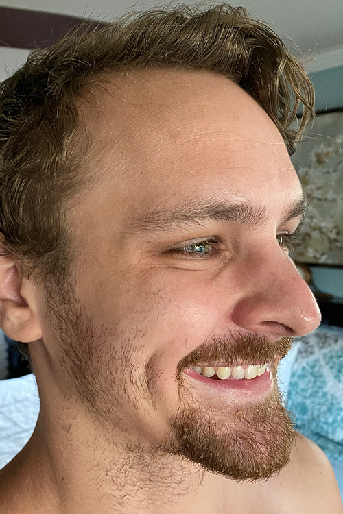 Botox and Dysport Before & After Gallery - Patient 404936 - Image 4